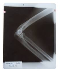 EVEL KNIEVEL X-RAY AFTER 1975 WEMBLEY STADIUM CRASH