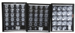 PELÉ MAY 9, 2006, MRI HEAD SCANS